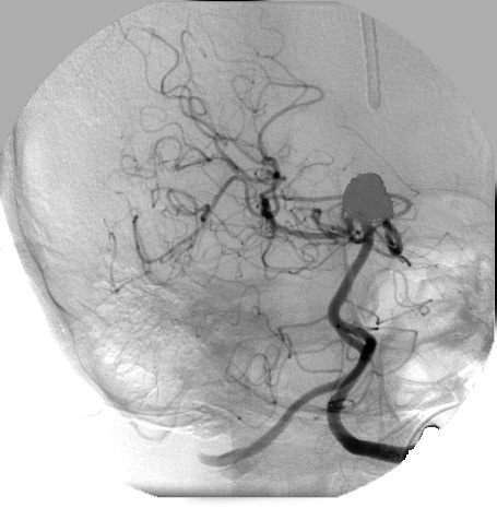 15A1 Aneurysm, coiled, infarct, subacute (Case 15) Angiogram 3 - Copy