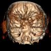 15A2 Aneurysm, coiled, infarct, subacute (Case 15) MRI CTA - Copy