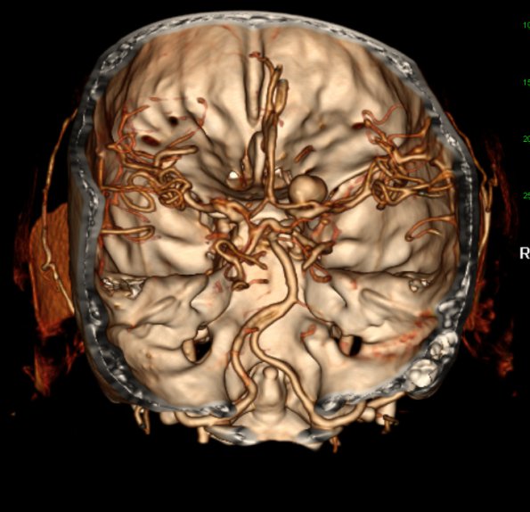 15A2 Aneurysm, coiled, infarct, subacute (Case 15) MRI CTA - Copy