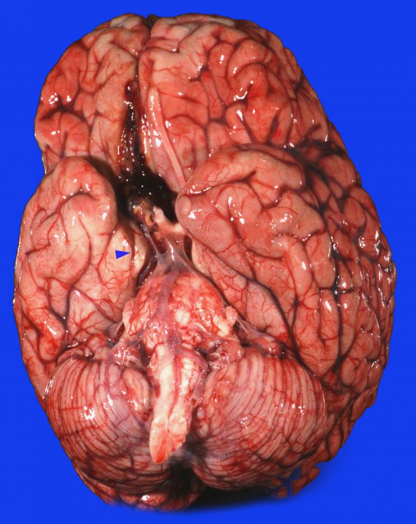 15B1 Aneurysm, coiled, infarct, subacute (Case 15)_2 copy