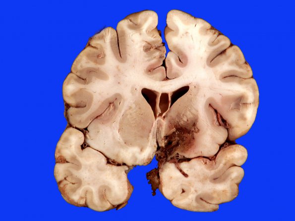 15B3 Aneurysm, coiled, infarct, subacute (Case 15)_11