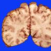 15B4 Aneurysm, coiled, infarct, subacute (Case 15)_12