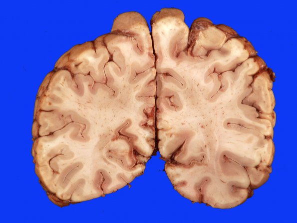 15B4 Aneurysm, coiled, infarct, subacute (Case 15)_12