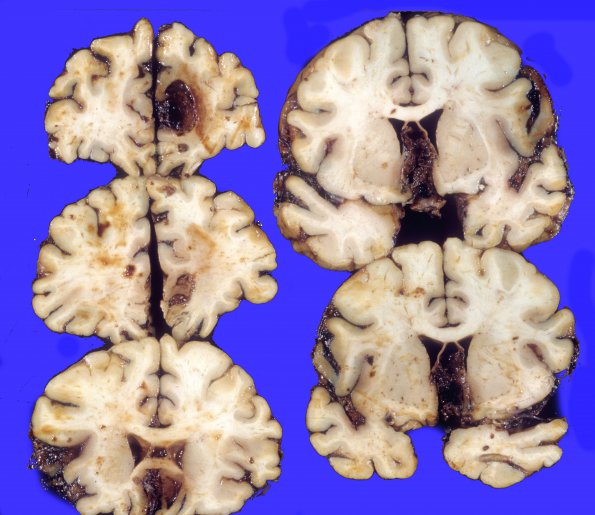 16A2 Aneurysm, ACA & hemorrhage (Case 16) 2