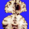 16A3 Aneurysm, ACA & hemorrhage (Case 16) 1