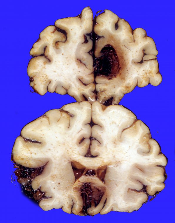 16A3 Aneurysm, ACA & hemorrhage (Case 16) 1