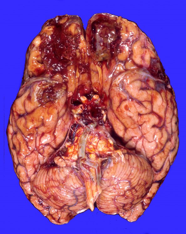 17A1 Contusion, 1 mo & remote Hx (Case 17) 2