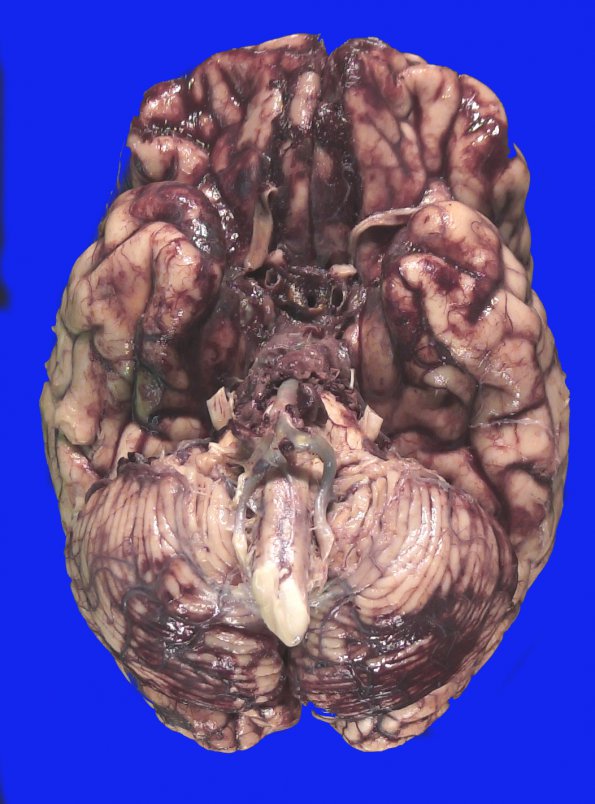 18A1 Aneurysm, ruptured 11 days (Case 18) _4