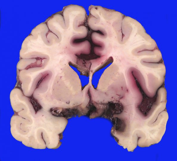 18A5  Aneurysm, ruptured 11 days (Case 18) _13