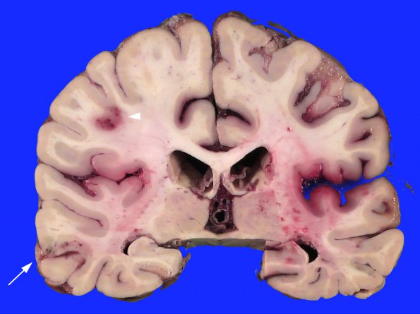 18A6 Aneurysm, ruptured 11 days (Case 18) _4 copyA