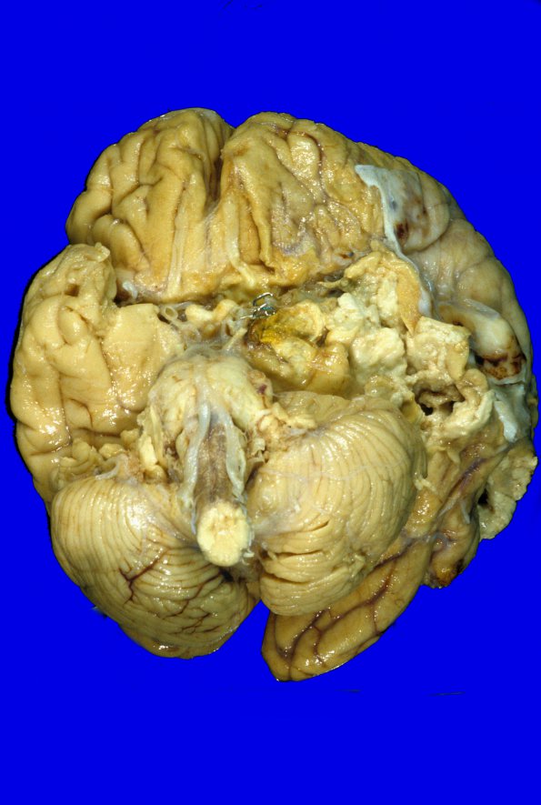 19A1 Aneurysm (Case 19) sp clipping gross 1