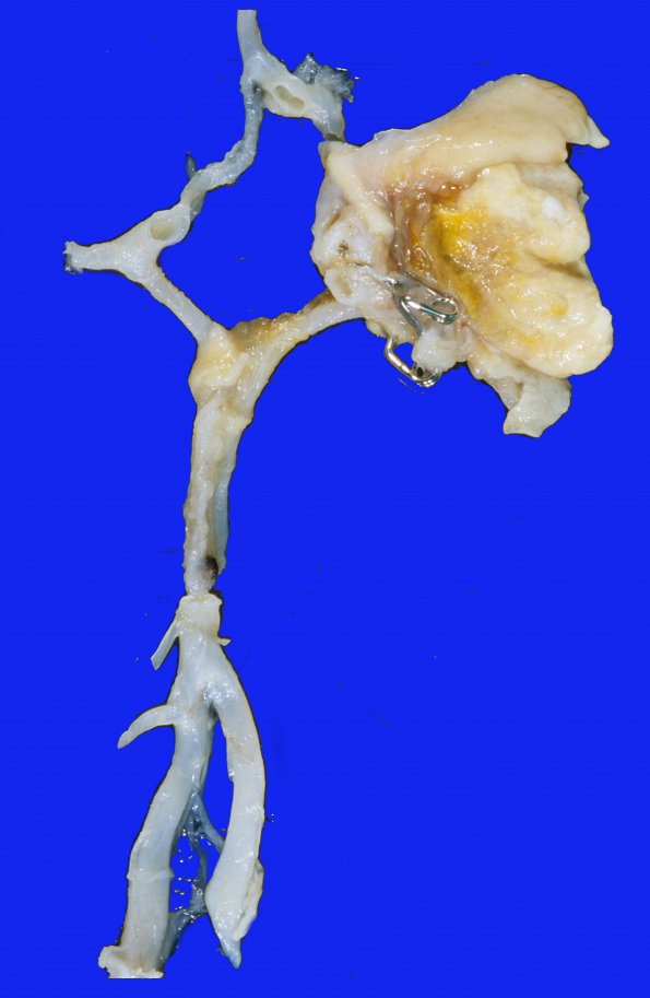 19A3A Aneurysms, multiple SP rupture and clipping (Case 19) A2