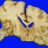 19A4 Aneurysms, multiple SP rupture and clipping x3 (Case 19) A6 - Copy