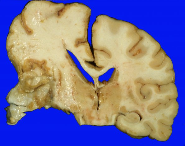 19A4 Aneurysms, multiple SP rupture and clipping x3 (Case 19) A6 - Copy