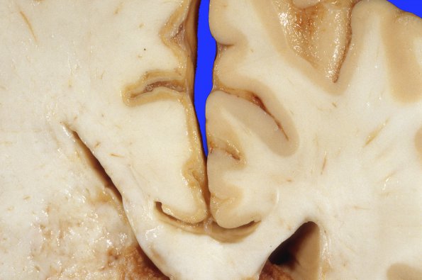 19A5 Aneurysms, multiple SP rupture and clipping x3 (Case 19) A9 - Copy