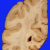 19A6 Aneurysms, multiple SP rupture and clipping (Case 19) A4