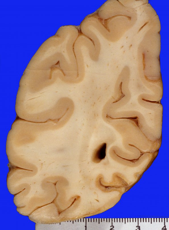 19A6 Aneurysms, multiple SP rupture and clipping (Case 19) A4