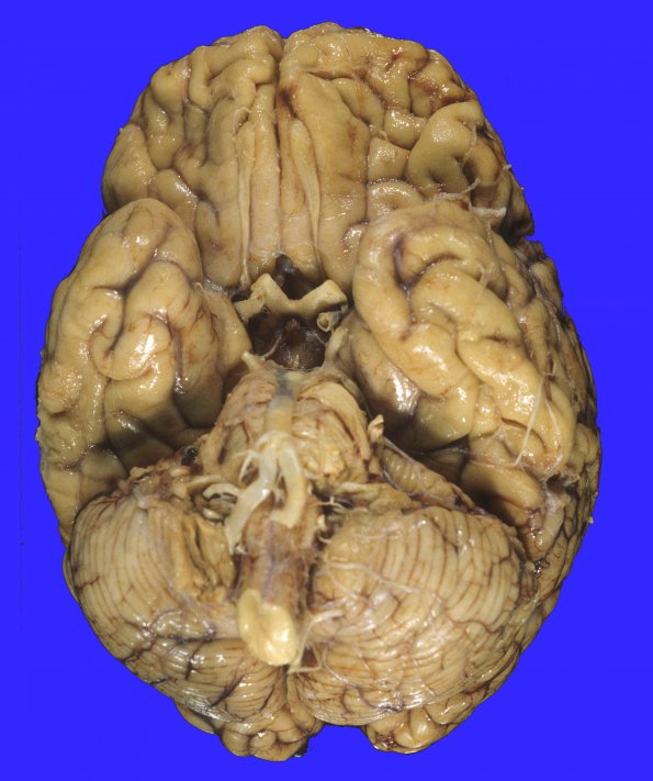 1A1 Aneurysm, R MCA & microinfarcts (Case 1) 2