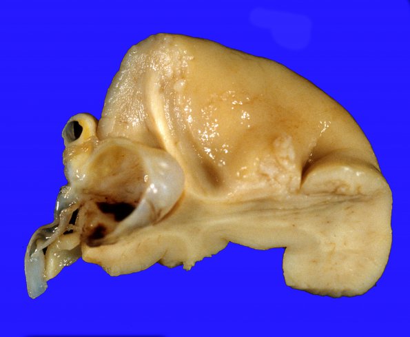 1A2 Aneurysm, R MCA & microinfarcts (Case 1) 1