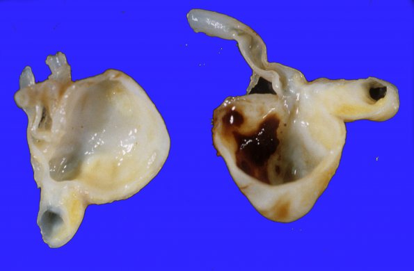 1A3 Aneurysm, R MCA & microinfarcts (Case 1) 4