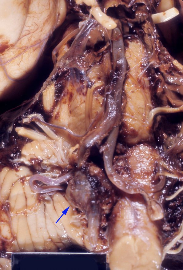 20A1 Aneurysm, vertebral (Case 20) 1 copy