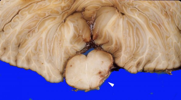 20A3 Aneurysm, vertebral (Case 20) 2 copy