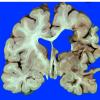 21A2 Aneurysm, clip, infarct, ulegyria (Case 21) _4