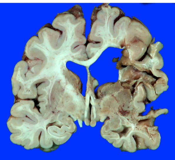 21A2 Aneurysm, clip, infarct, ulegyria (Case 21) _4