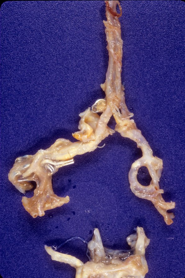 22A2 Aneurysms, multiple, clipped (Case 22) 2