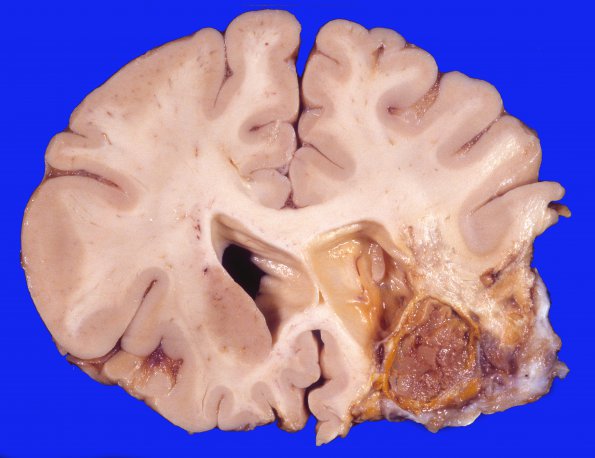 22A3 Aneurysms, multiple, clipped (Case 22) 1