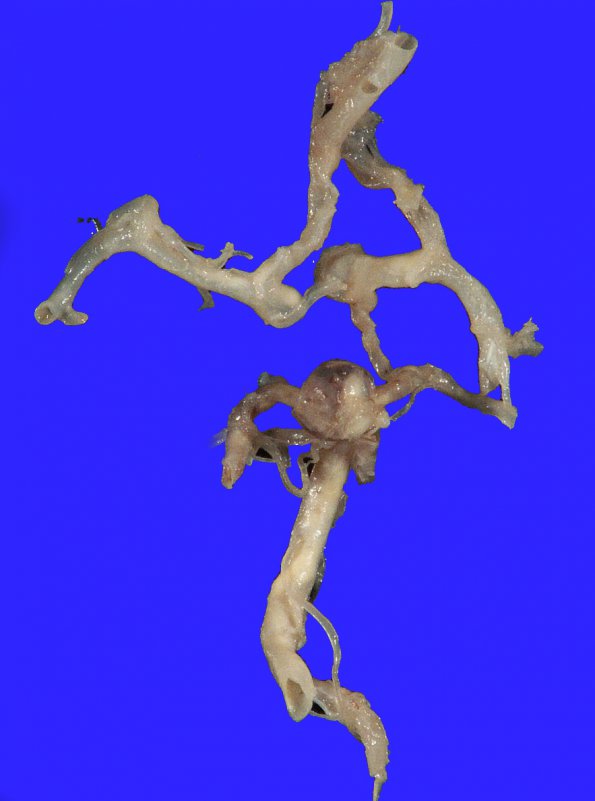 2A1 Aneurysm (Case 2) gross_3