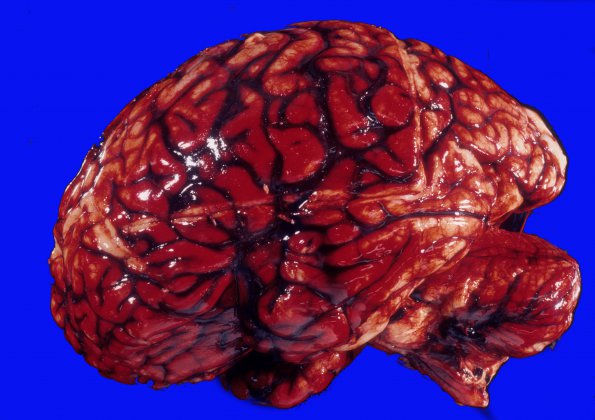 3A1 Aneurysm, hemorrhage (Case 3) 3