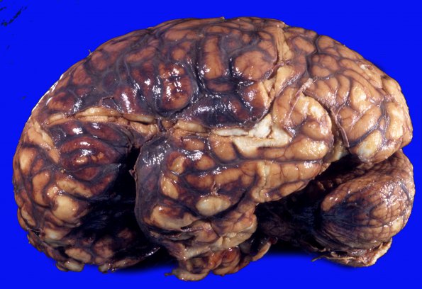 3A2 Aneurysm, hemorrhage (Case 3) 4