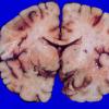 3A3 Aneurysm, hemorrhage (Case 3) 2