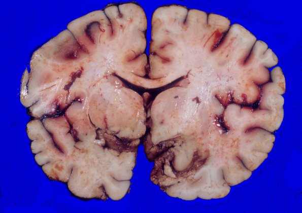 3A3 Aneurysm, hemorrhage (Case 3) 2