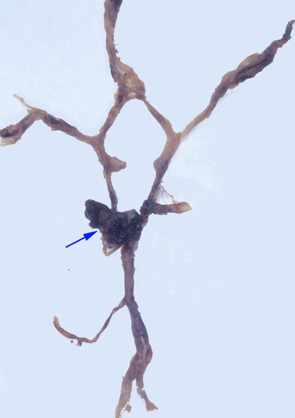 3A4 Aneurysm, hemorrhage (Case 3) 1 (2) copy