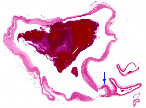 3B1 Aneurysm (Case 3) H&E 1 copy