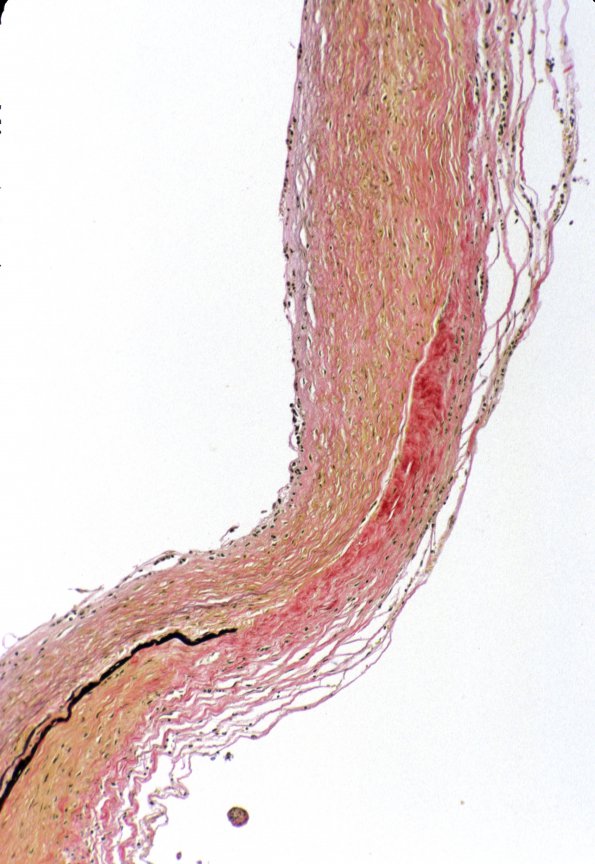 3B3 Aneurysm (Case 3) VVG 1