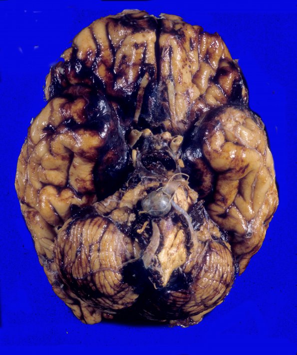 4A1 Aneurysm, Basilar-Vertebral, coiled (Case 4) 4