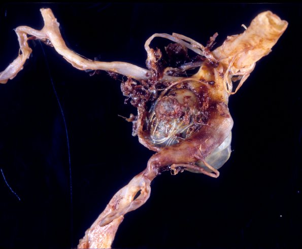 4A3 Aneurysm, Basilar-Vertebral, coiled (Case 4) 1