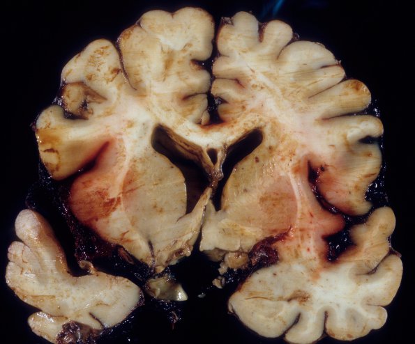 4A5 Aneurysm, Basilar-Vertebral, coiled (Case 4) 8