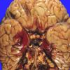 5A1 Hemorrhage, subarachnoid (Case 5) vertebral aneurysm 1 copy