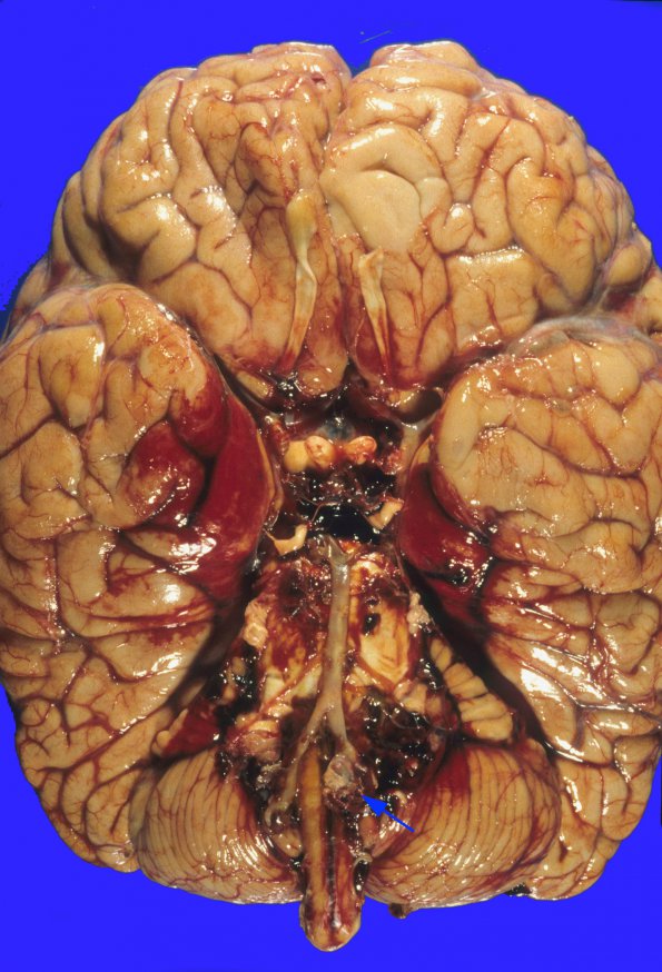 5A1 Hemorrhage, subarachnoid (Case 5) vertebral aneurysm 1 copy