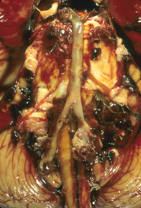 5A2 Hemorrhage, subarachnoid (Case 5) vertebral aneurysm 2