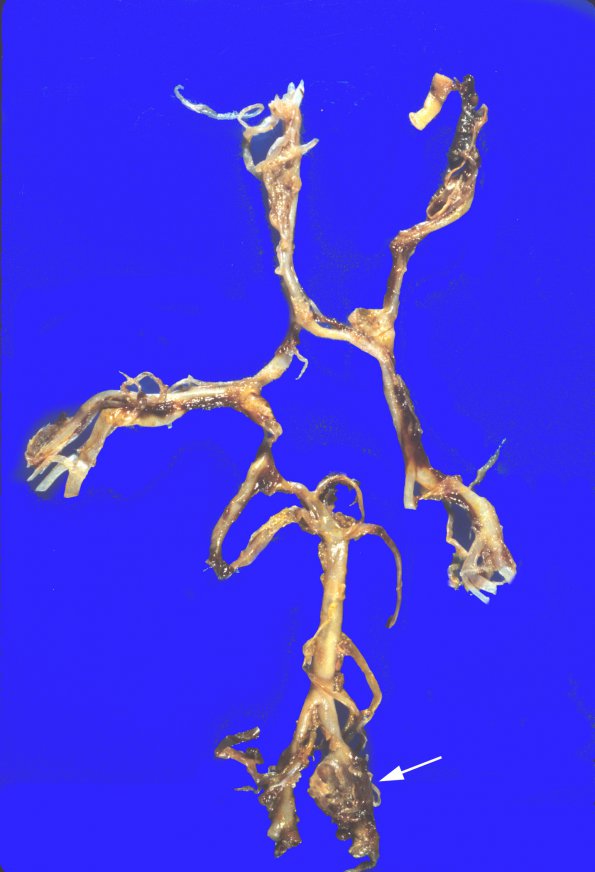 5A3 Aneurysm, saccular (Case 5) vertebral 4 copy