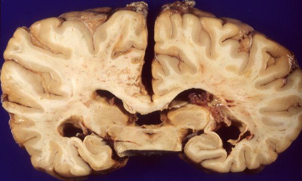 5A5 Aneurysm, saccular (Case 5) vertebral 5