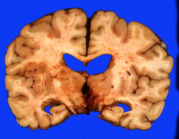 6A3 Aneurysm, basilar tip, ruptured (Case 6) 2