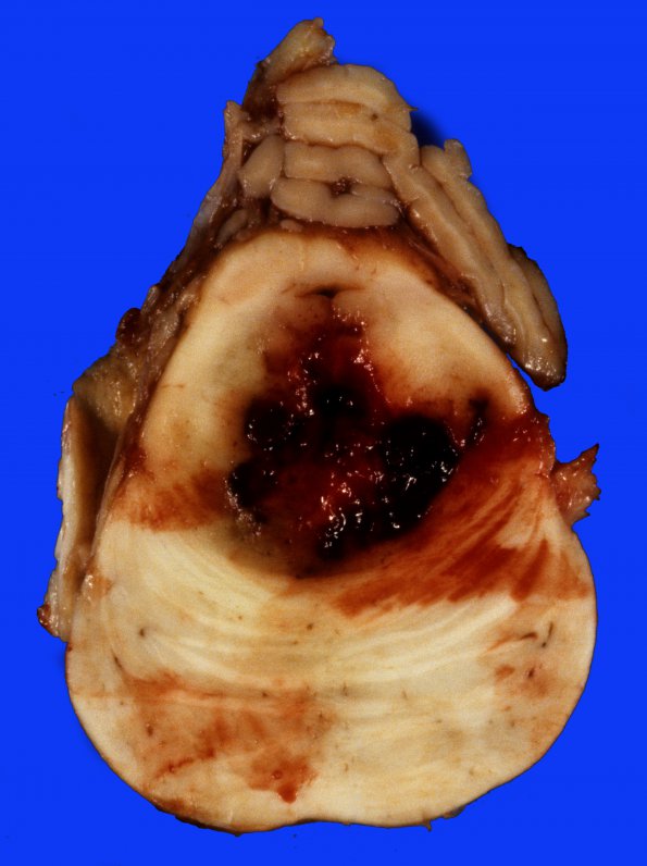 6A4 Aneurysm, basilar tip, ruptured (Case 6) 7