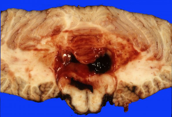 6A5 Aneurysm, basilar tip, ruptured (Case 6) 3