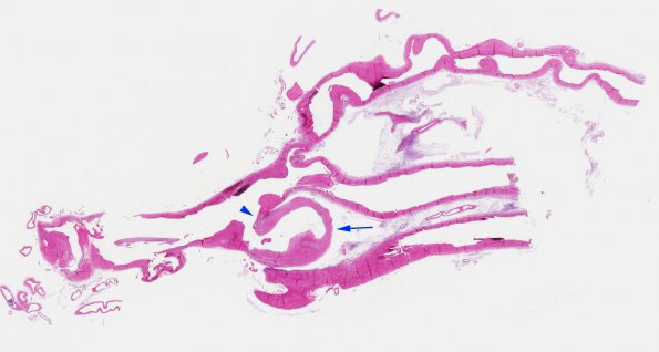 7B1 Aneurysm, ACA (Case 7) H&E whole mount copy